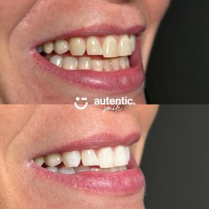 Resultado real de blanqueamiento dental Autentic Smile - caso 1 (antes y despues)