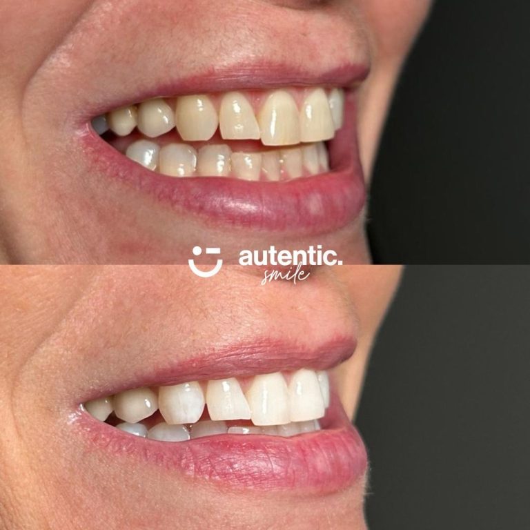 Resultado real de blanqueamiento dental Autentic Smile - caso 1 (antes y despues)