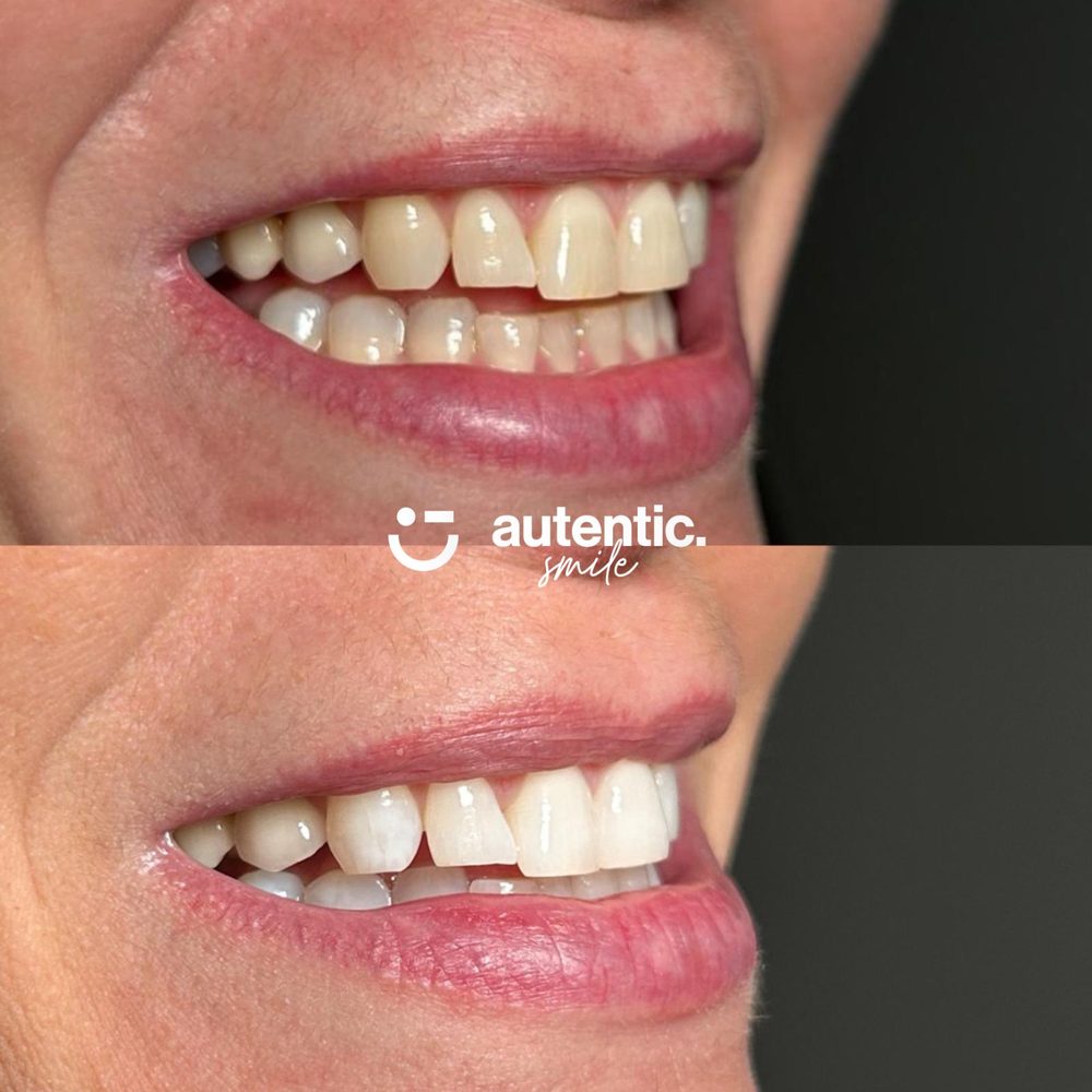 Resultado real de blanqueamiento dental Autentic Smile, caso 1: antes y después