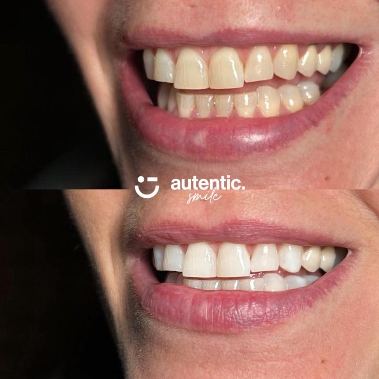 Resultado real de blanqueamiento dental Autentic Smile - caso 1 (antes y despues)