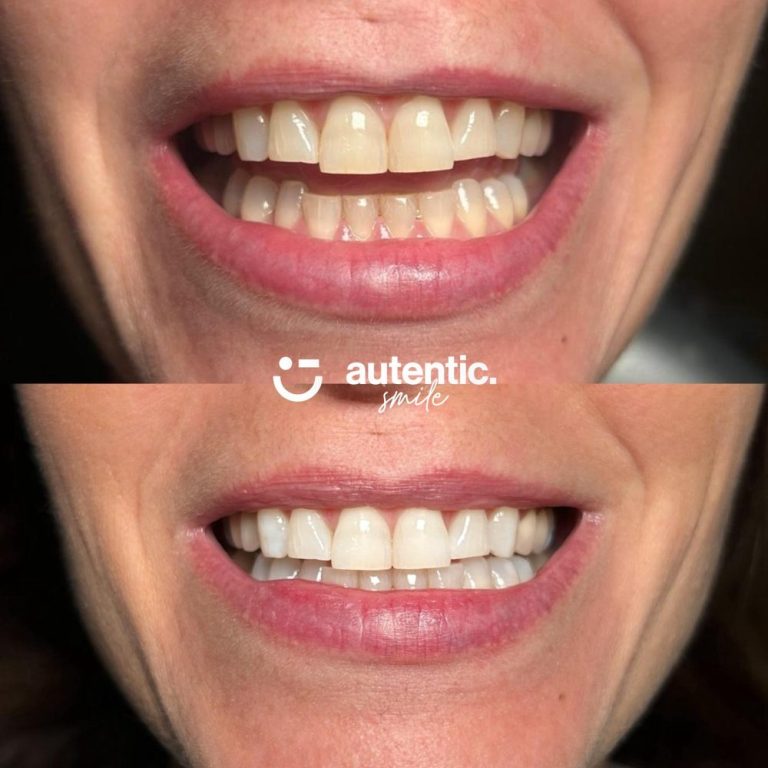 Resultado real de blanqueamiento dental Autentic Smile - caso 1 (antes y despues)