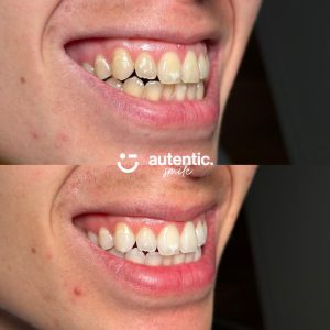 Resultado real de blanqueamiento dental Autentic Smile - caso 2 (antes y despues)