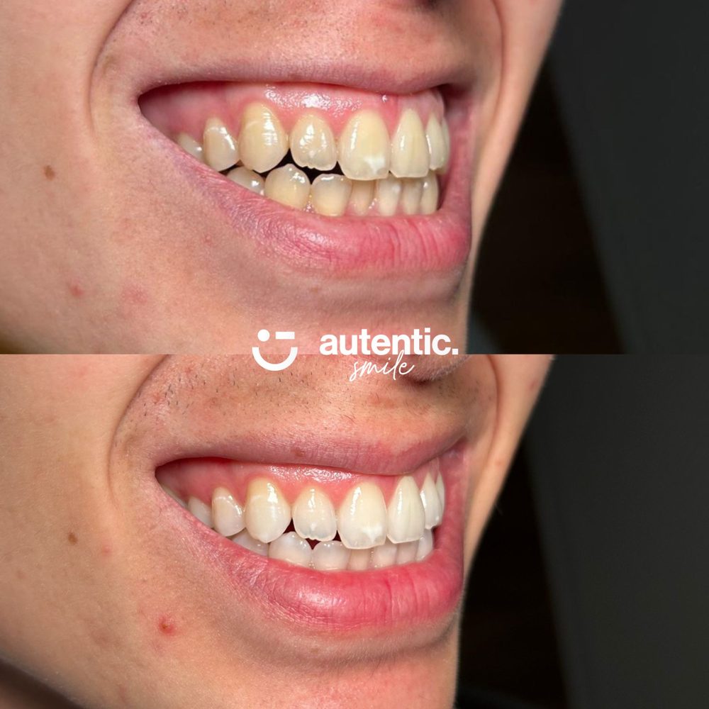 Resultado real de blanqueamiento dental Autentic Smile, caso 2: antes y después