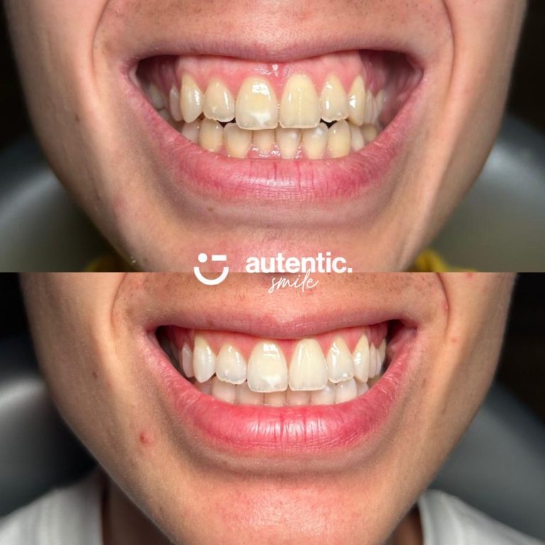 Resultado real de blanqueamiento dental Autentic Smile - caso 2 (antes y despues)