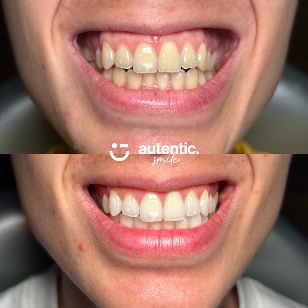 Resultado real de blanqueamiento dental Autentic Smile, caso 2: los mismos dientes antes y después