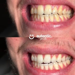Resultado real de blanqueamiento dental Autentic Smile - caso 3 (antes y despues)