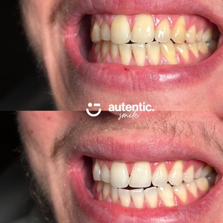 Resultado real de blanqueamiento dental Autentic Smile - caso 3 (antes y despues)