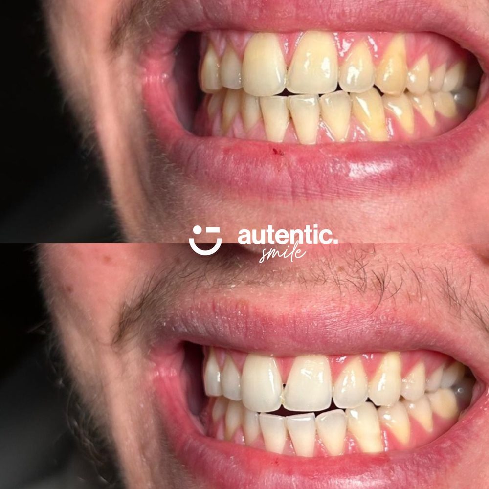 Resultado real de blanqueamiento dental Autentic Smile, caso 3: antes y después