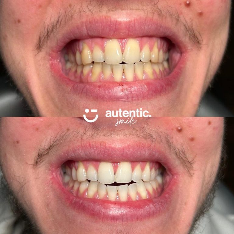 Resultado real de blanqueamiento dental Autentic Smile - caso 3 (antes y despues)
