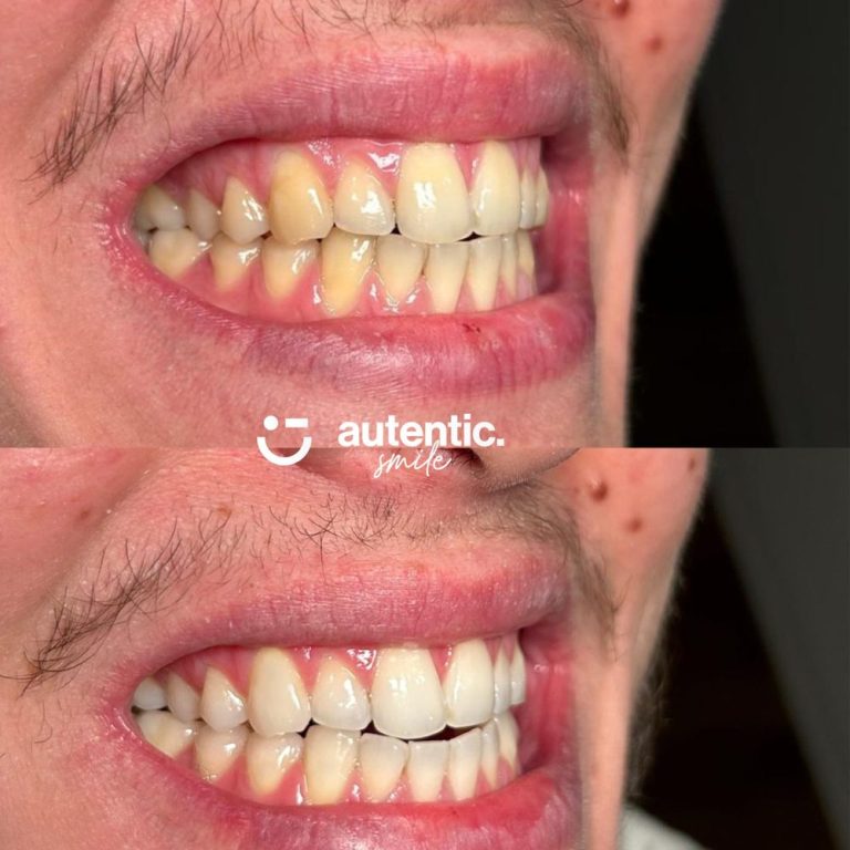 Resultado real de blanqueamiento dental Autentic Smile - caso 3 (antes y despues)