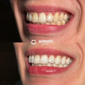 Resultado real de blanqueamiento dental Autentic Smile - caso 4 (antes y despues)