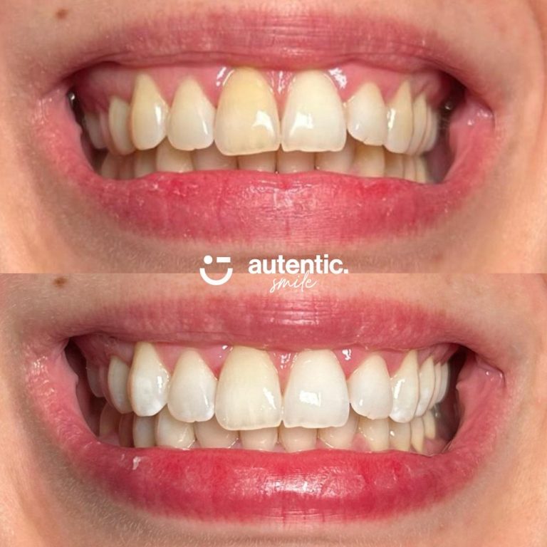Resultado real de blanqueamiento dental Autentic Smile - caso 4 (antes y despues)