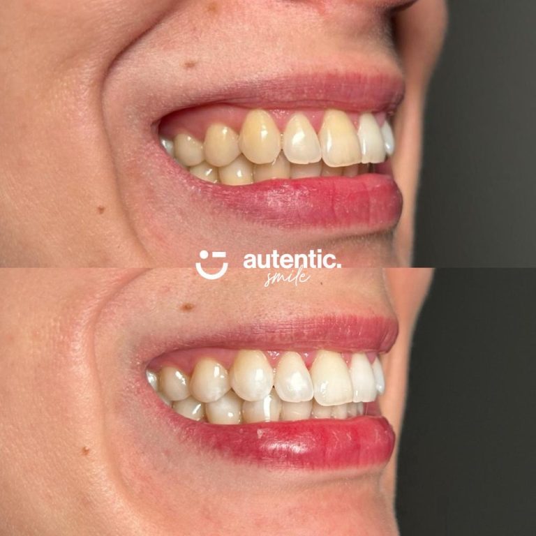 Resultado real de blanqueamiento dental Autentic Smile - caso 4 (antes y despues)