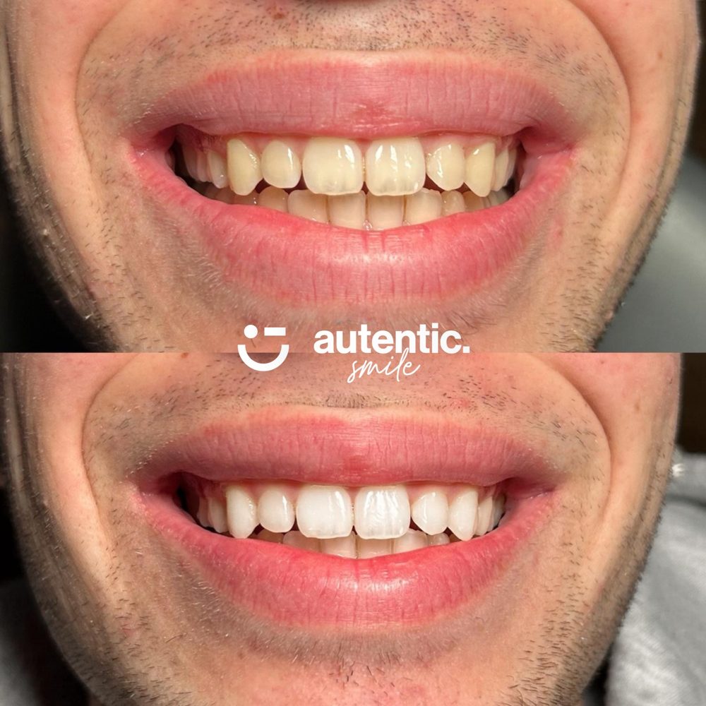 Resultado real de blanqueamiento dental Autentic Smile, caso 5: antes y después