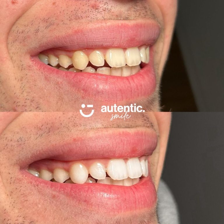 Resultado real de blanqueamiento dental Autentic Smile - caso 5 (antes y despues)