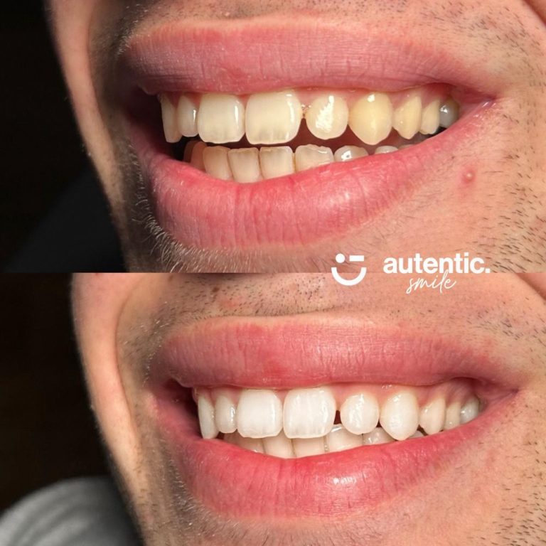 Resultado real de blanqueamiento dental Autentic Smile - caso 5 (antes y despues)