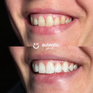 Resultado real de blanqueamiento dental Autentic Smile - caso 6 (antes y despues)