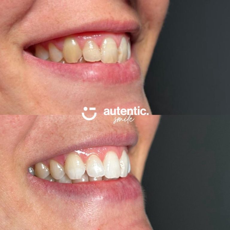 Resultado real de blanqueamiento dental Autentic Smile - caso 6 (antes y despues)