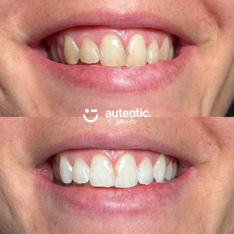 Resultado real de blanqueamiento dental Autentic Smile - caso 6 (antes y despues)