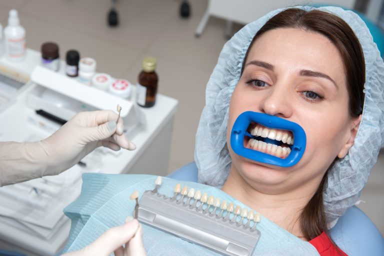 Blanqueamiento dental: paciente con separador labial en el sillón mientras el dentista compara el tono con una guía de color