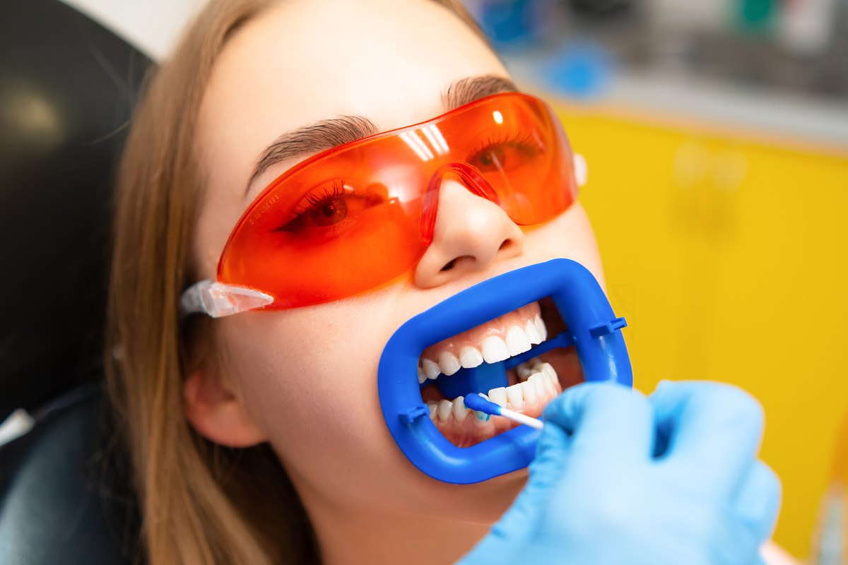 Blanqueamiento dental y sensibilidad: el dentista aplica un gel sobre los dientes de una paciente con separador labial