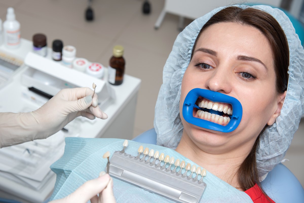 Blanqueamiento dental: paciente con separador labial en el sillón mientras el dentista compara el tono con una guía de color