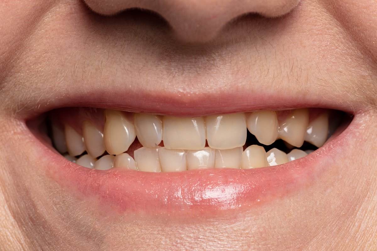 Sonrisa de cerca con los dientes de tono amarillento